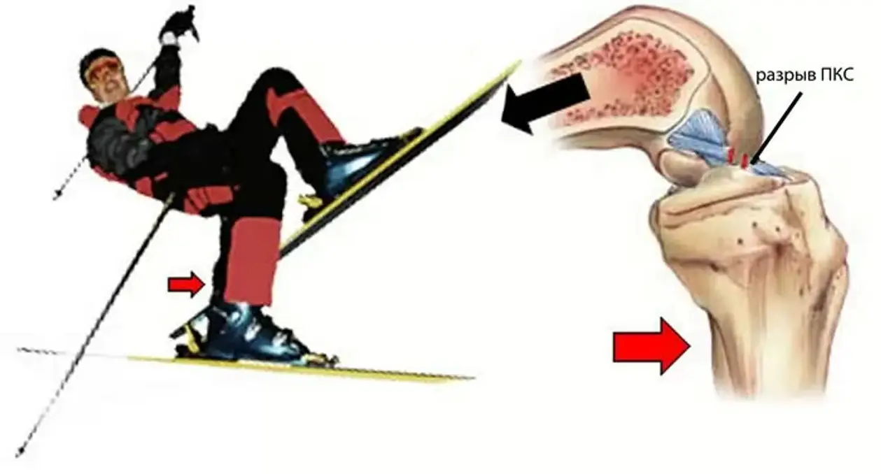 Взять разрыв. Разрыв связок коленного сустава ПКС операция. Частичное разволокнение передней крестообразной связки. Задняя крестообразная связка ЗКС. Механизм повреждения ПКС коленного.